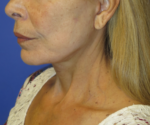 FACEology Lift / Neck Lift