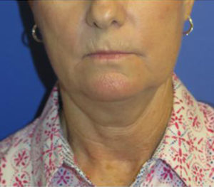 FACEology Lift / Neck Lift Case 5954 Before Photo FACEology Lift / Neck Lift