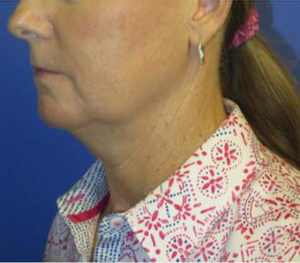 FACEology Lift / Neck Lift Case 5954 Before Photo FACEology Lift / Neck Lift