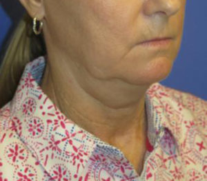 FACEology Lift / Neck Lift Case 5954 Before Photo FACEology Lift / Neck Lift