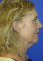 FACEology Lift / Neck Lift