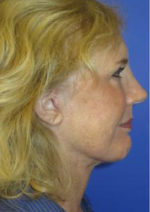 FACEology Lift / Neck Lift