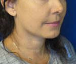 FACEology Lift / Neck Lift