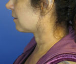 FACEology Lift / Neck Lift