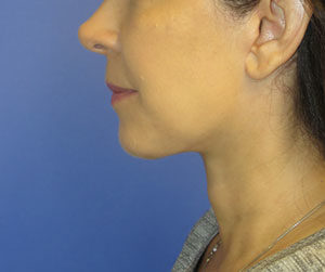 FACEology Lift / Neck Lift Case 6132 After Photo FACEology Lift / Neck Lift