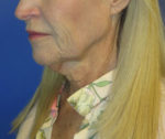 FACEology Lift / Neck Lift