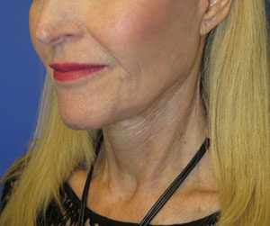 FACEology Lift / Neck Lift Case 6118 After Photo FACEology Lift / Neck Lift
