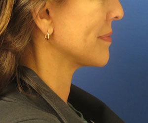 FACEology Lift / Neck Lift Case 6126 After Photo FACEology Lift / Neck Lift