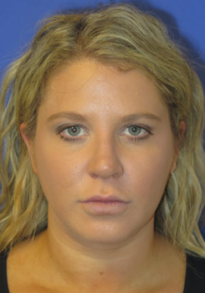 Chin Implant Case 6081 After Photo Chin Implant