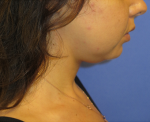 Chin Implant Case 6061 Before Photo Chin Implant