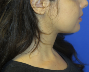 Chin Implant Case 6061 After Photo Chin Implant