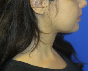 Chin Implant