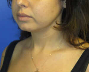 Chin Implant Case 6061 Before Photo Chin Implant