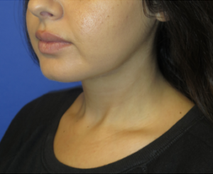 Chin Implant Case 6061 After Photo Chin Implant