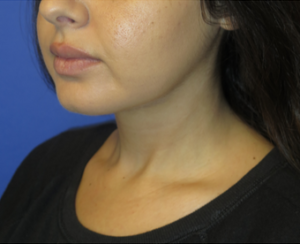 Chin Implant