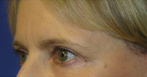 Eyelid Lift Case 6071 After Photo Eyelid Lift