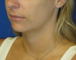 Chin Implant Case 6084 Before Photo Chin Implant