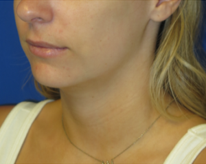 Chin Implant