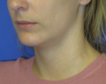 Chin Implant