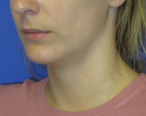 Chin Implant Case 6084 After Photo Chin Implant