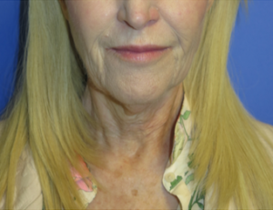 Laser Resurfacing Case 6087 Before Photo Laser Resurfacing