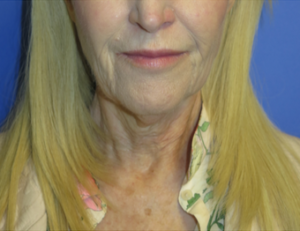 Laser Resurfacing