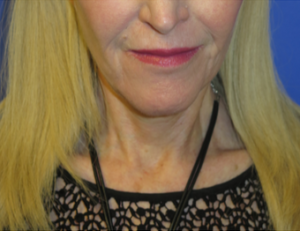 Laser Resurfacing Case 6087 After Photo Laser Resurfacing