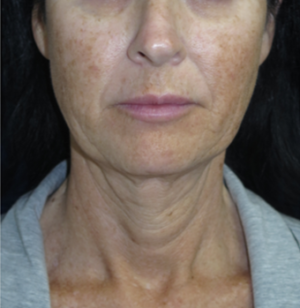 FACEology Lift / Neck Lift