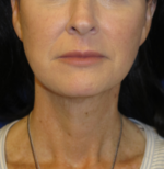 FACEology Lift / Neck Lift