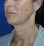 FACEology Lift / Neck Lift