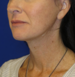 FACEology Lift / Neck Lift