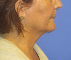 FACEology Lift / Neck Lift