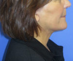 FACEology Lift / Neck Lift