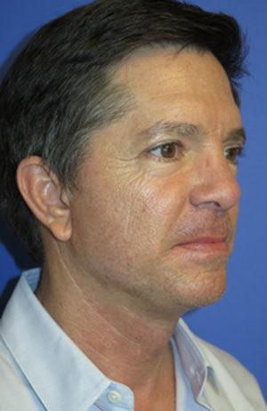 FACEology Lift / Neck Lift Case 6121 After Photo FACEology Lift / Neck Lift