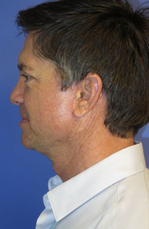 FACEology Lift / Neck Lift Case 6121 After Photo FACEology Lift / Neck Lift
