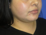Buccal Fat Reduction