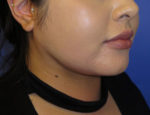 Buccal Fat Reduction