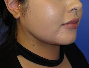 Buccal Fat Reduction Case 6104 After Photo Buccal Fat Reduction