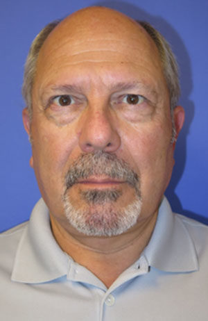 FACEology Lift / Neck Lift Case 6113 After Photo FACEology Lift / Neck Lift