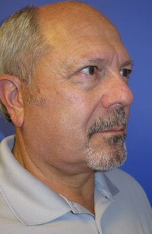 FACEology Lift / Neck Lift Case 6113 After Photo FACEology Lift / Neck Lift