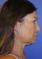 FACEology Lift / Neck Lift