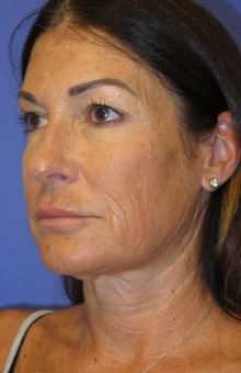 FACEology Lift / Neck Lift Case 6189 Before Photo FACEology Lift / Neck Lift