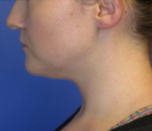 Chin Liposuction Case 6194 Before Photo Chin Liposuction