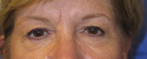 Eyelid Lift Case 6186 Before Photo Eyelid Lift