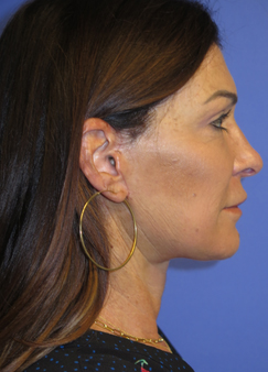 FACEology Lift / Neck Lift Case 6189 After Photo FACEology Lift / Neck Lift