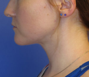 Chin Liposuction Case 6194 After Photo Chin Liposuction