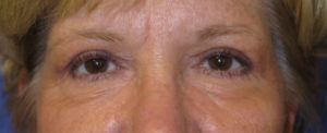 Eyelid Lift Case 6186 After Photo Eyelid Lift