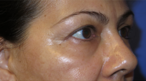 Eyelid Lift Case 6215 Before Photo Eyelid Lift