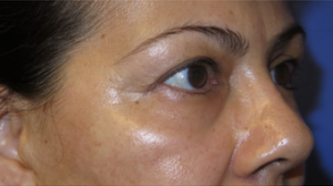 Eyelid Lift