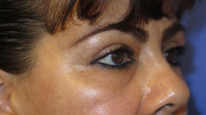 Eyelid Lift Case 6215 After Photo Eyelid Lift